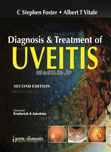 Diagnosis & Treatment of Uveitis