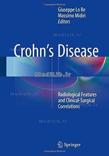 Crohn’s Disease