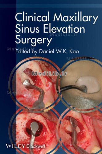 Clinical Maxillary Sinus Elevation Surgery
