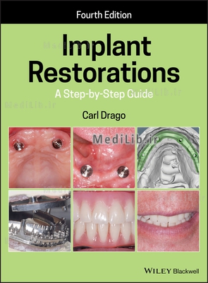 Implant Restorations: A Step-by-Step Guide (4th Edition)