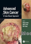 Advanced Skin Cancer