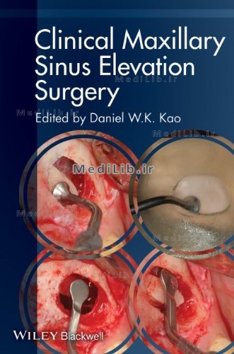 Clinical Maxillary Sinus Elevation Surgery